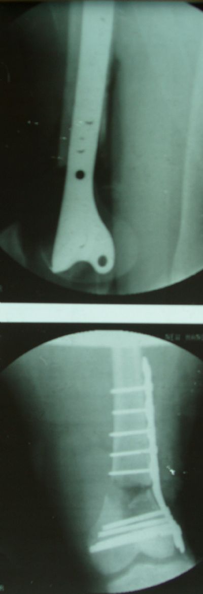 Locking Supracondylar Plate (Implant 183)